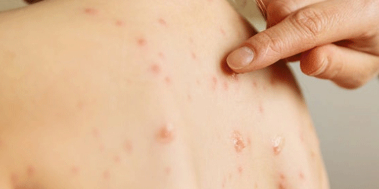 Measles Resurfaces in Sri Lanka After Years of Elimination