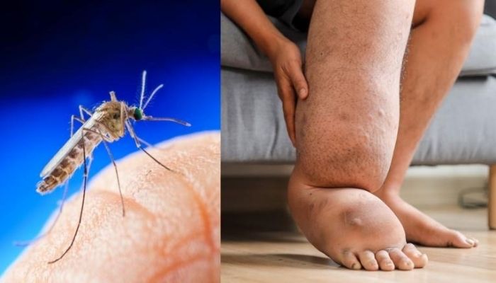 Sri Lanka records 68 filariasis cases in 2025, half among Indian workers
